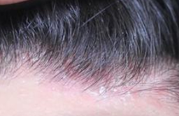 教你了解脂溢性皮炎及其治疗方法