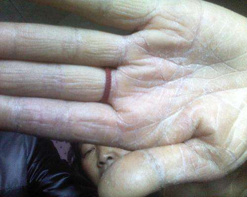 冬天手脱皮是怎么回事 这些方法可以帮助你