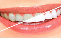 爱美的朋友不要错过，怎么让牙齿变白