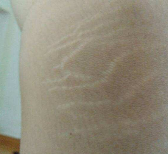 爱美女生关注的生长纹怎么去除