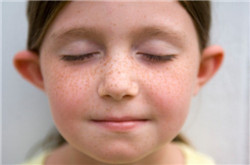 如何有效去除黄褐斑 黄褐斑的治疗要内外结合