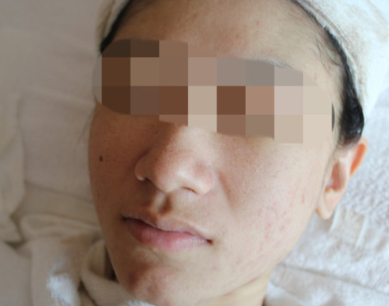 女性朋友最关注怎么除痘坑的问题