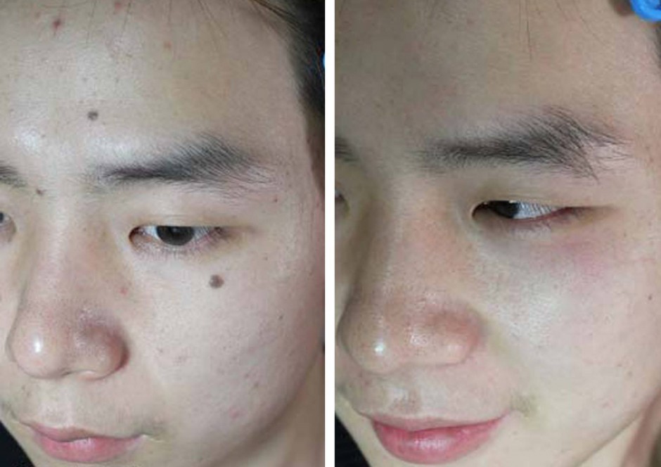 点痣后的注意事项须知 五要点需做好