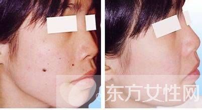 点痣后的注意事项须知 五要点需做好