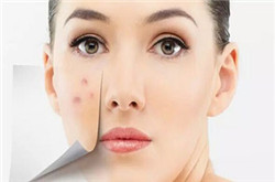 脸部祛痘的方式方法