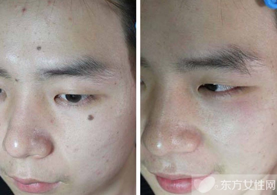 点痣后的注意事项须知 五要点需做好