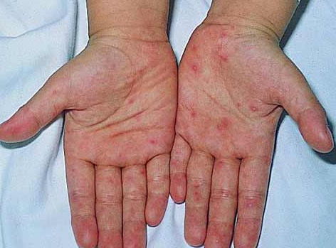 手足口病防治知识与注意事项