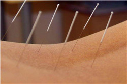 针灸减肥有副作用吗 研究表明存在副作用