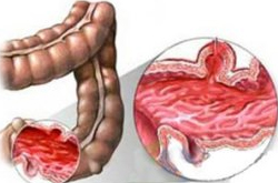清晰病症 4种中医直肠炎的治疗方法