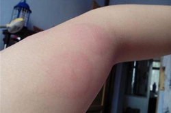 慢性荨麻疹怎么办 治疗慢性荨麻疹的偏方