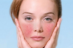 教你5个小妙招改善红血丝