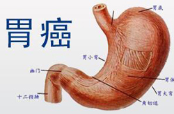 胃癌晚期症状与饮食禁忌介绍