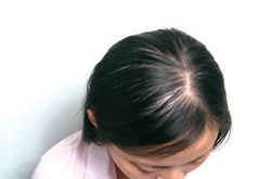 影响形象 斑秃最好的治疗方法介绍