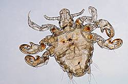 虱子咬的症状有哪些 怎样去除虱子