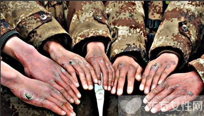 怎么治冻疮 几招教你怎样预防冻疮