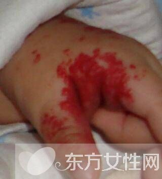 红胎记是什么 胎记怎么去除