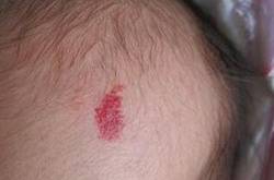 红胎记是什么 胎记怎么去除