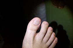 治疗灰指甲偏方有哪些 注意事项不可忘