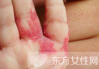 红胎记是什么 胎记怎么去除