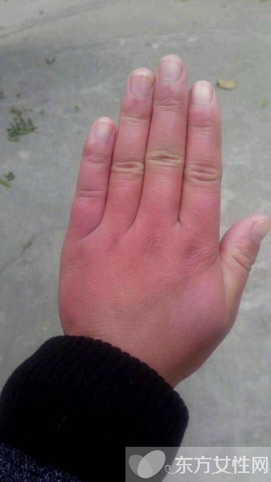 怎么治冻疮 几招教你怎样预防冻疮