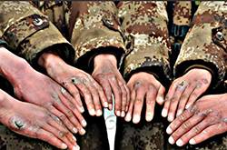 怎么治冻疮 几招教你怎样预防冻疮