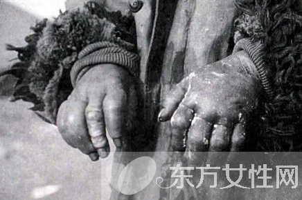 冬天冻伤怎么办 冻伤两大紧急处理办法