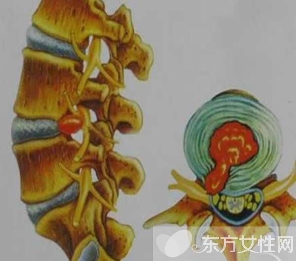 腰椎盘突出怎么锻炼 腰椎盘突出的4大病因
