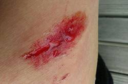 擦伤怎么自行处理 不同类型疤痕的治疗方法