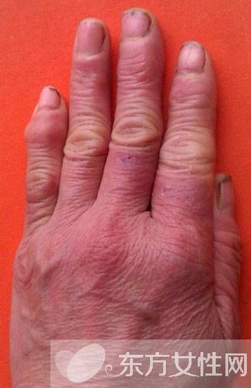 怎么治冻疮 几招教你怎样预防冻疮