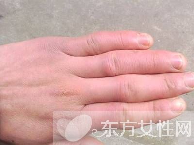 怎么治冻疮 几招教你怎样预防冻疮