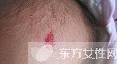 红胎记是什么 胎记怎么去除