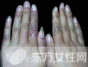 治疗冻疮的方法有哪些 8大方法帮你医治