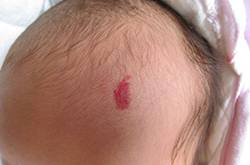 胎记的治疗方法有哪些 胎记是怎么产生的