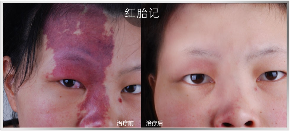 胎记是怎么形成的 怎么去除胎记