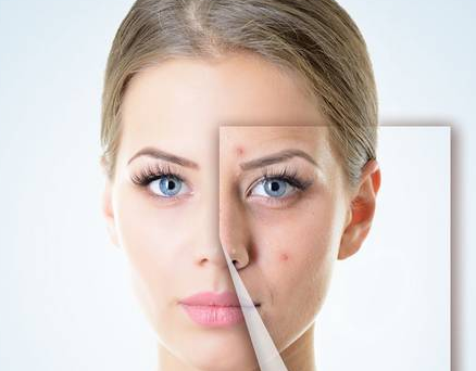 点痣后注意事项有哪些 点痣后不留疤痕要点