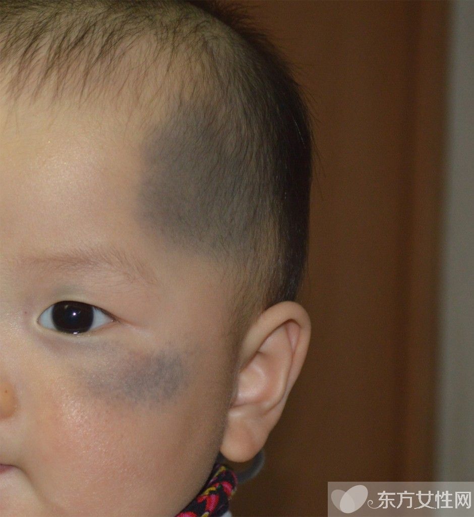 胎记是怎么形成的 胎记对命运也是有影响的哦