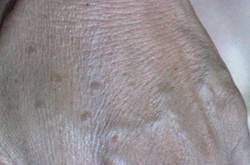 年轻人手上老年斑的原因