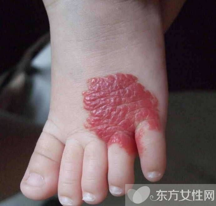 胎记是怎么形成的 胎记对命运也是有影响的哦