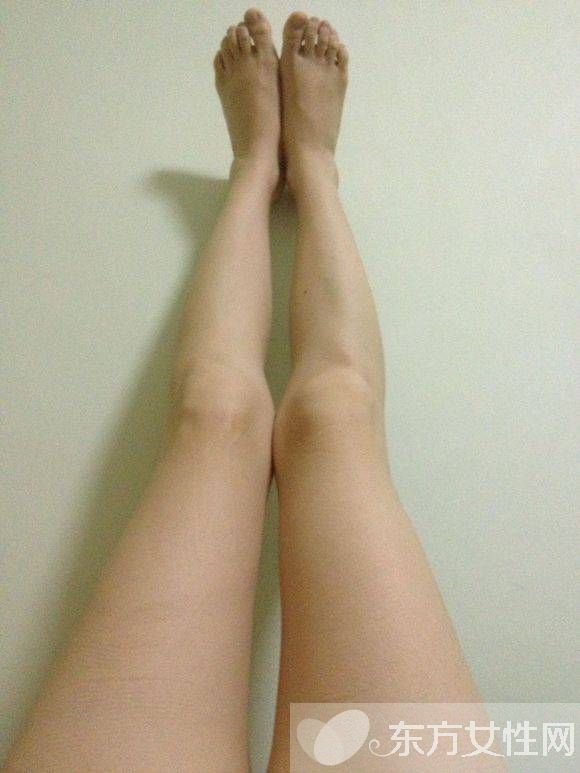罗圈腿怎么矫正 5个有效方法让你拥有一双美腿