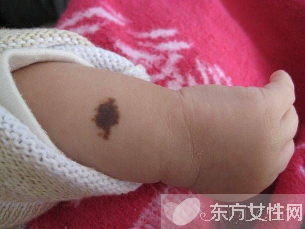 胎记怎么去除 激光去胎记的5大优势