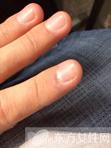 倒刺是什么 指甲倒刺的预防