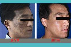 胎记是怎么形成的 怎么去除胎记