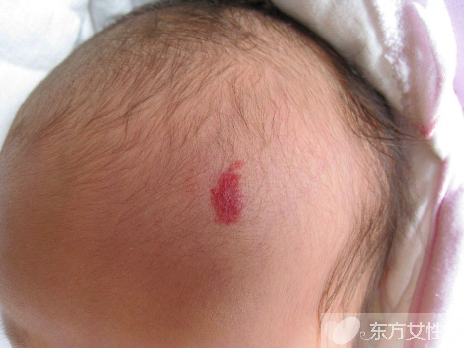 胎记的治疗方法有哪些 胎记是怎么产生的