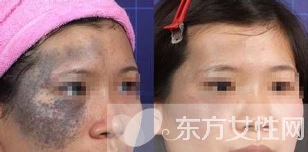 胎记的治疗方法有哪些 胎记是怎么产生的