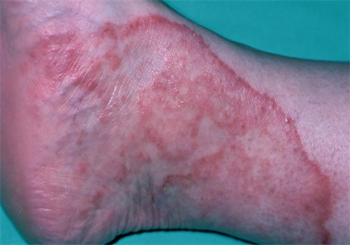 脚气产生的原因 去除脚气小编有办法