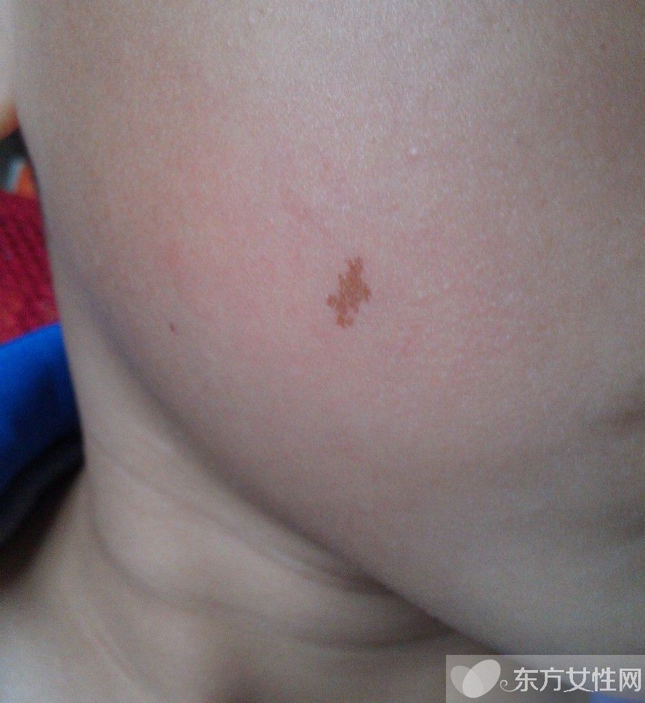 胎记是怎么形成的 胎记对命运也是有影响的哦