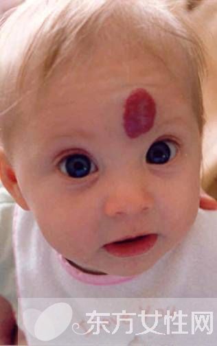 胎记的治疗方法有哪些 胎记是怎么产生的