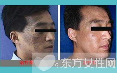 胎记是怎么形成的 怎么去除胎记