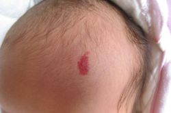 胎记是怎么形成的 胎记对命运也是有影响的哦