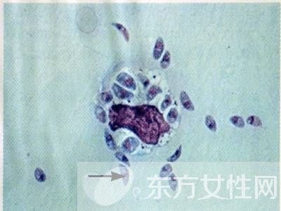 弓形虫病的症状是什么 7大健康饮食教你预防